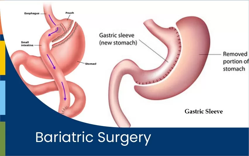 bariatric-surgery-jpg