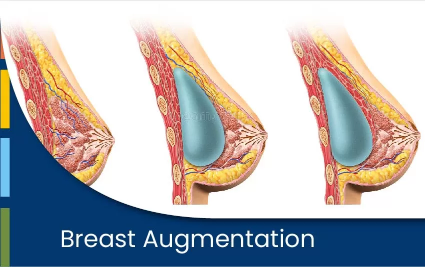 breast-augmentation-jpg
