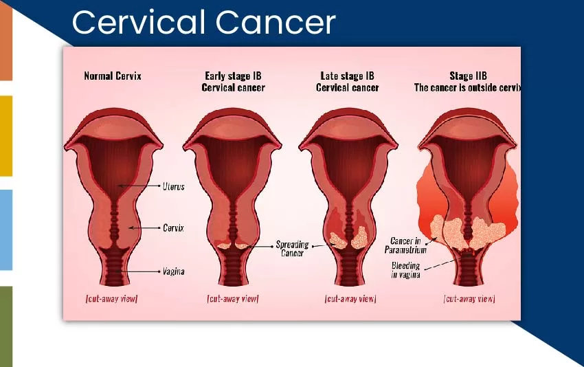 cervical-cancer-jpg