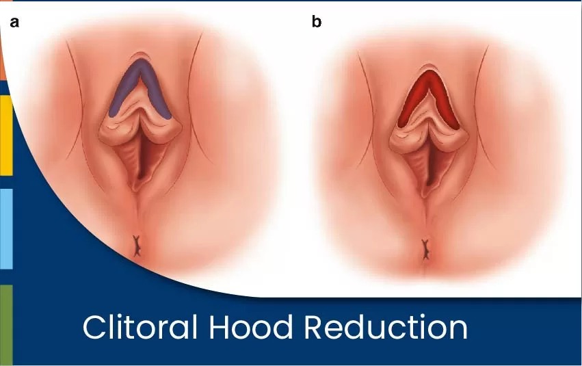 clitoral-hood-reduction-jpg