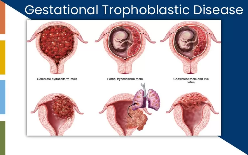 gestational-trophoblastic-disease-jpg