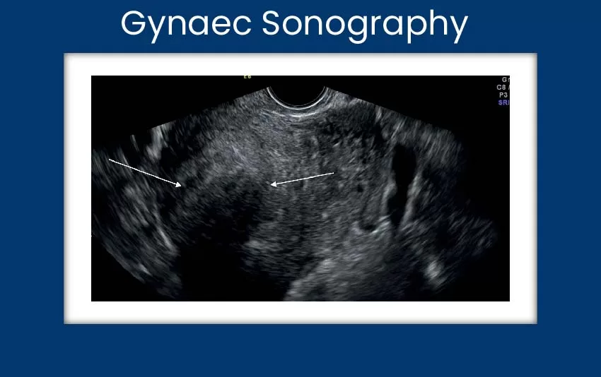gynaec-sonography-jpg