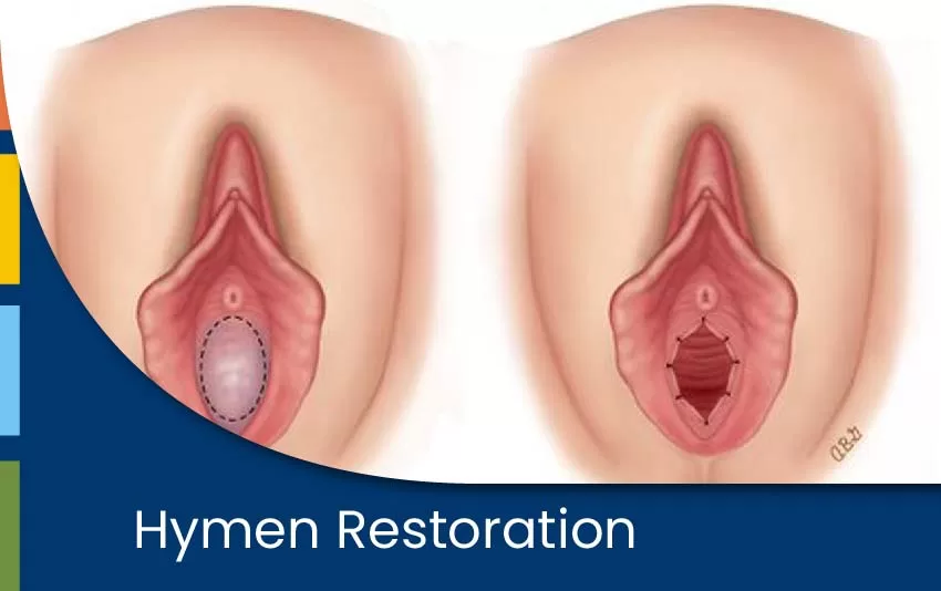 hymen-restoration-jpg
