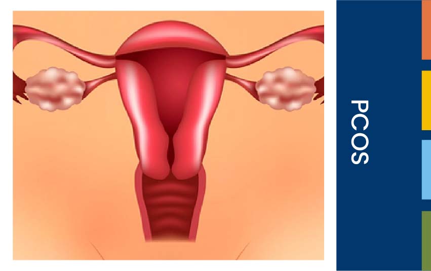 pcos (1)