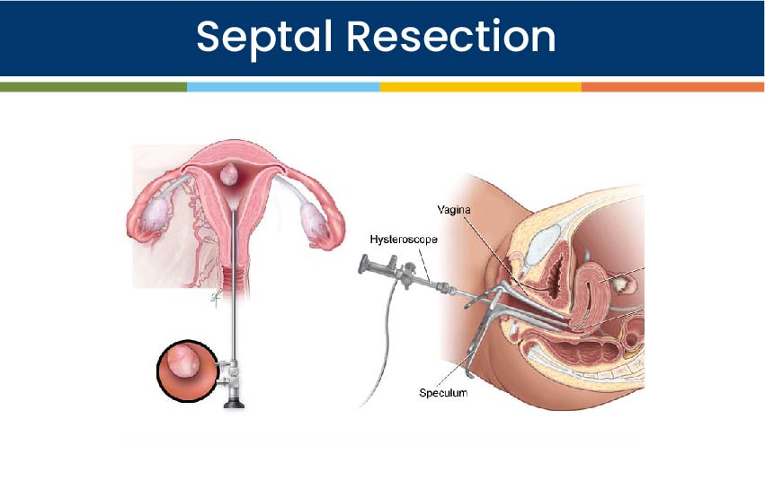 Septal Resection