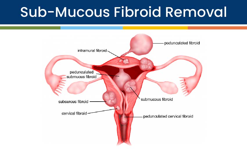 Sub-Mucous Fibroid Removal