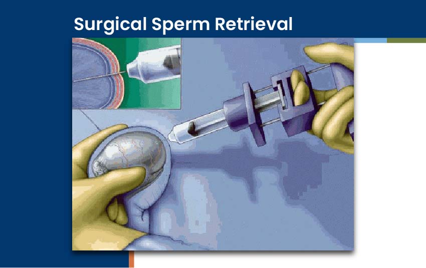 Surgical Sperm Retrieval