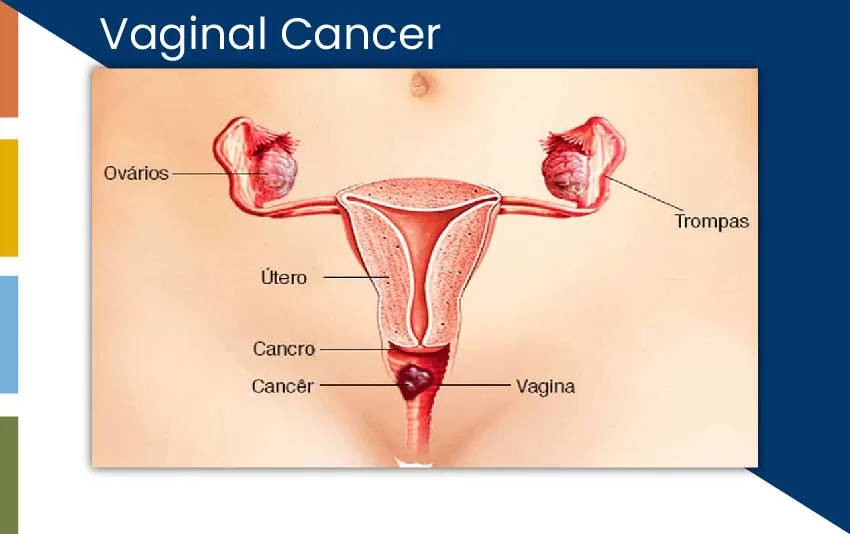 vaginal-cancer-jpg