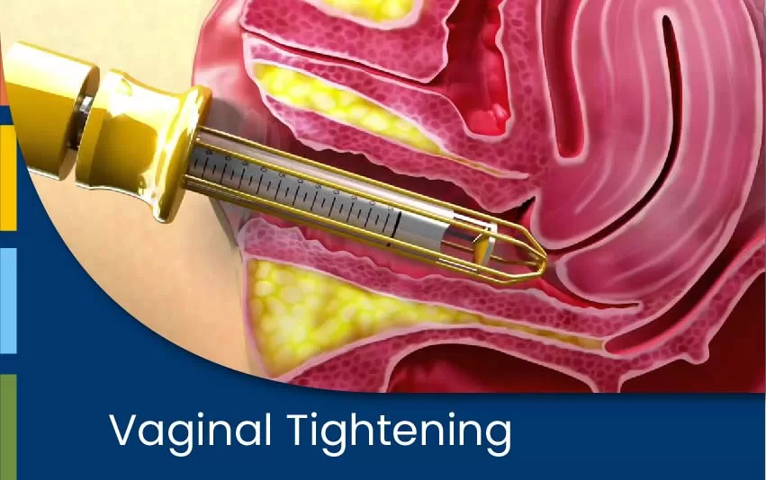 vaginal-tightening-jpg
