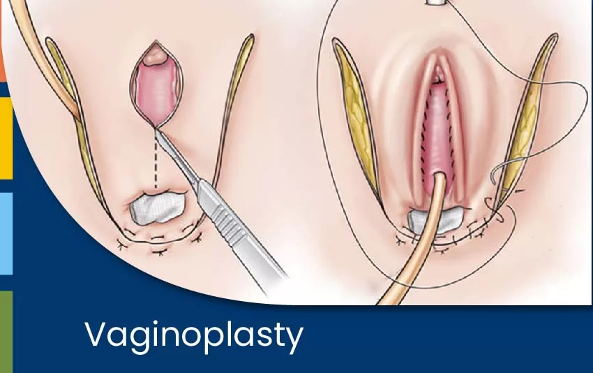vaginoplasty-jpg