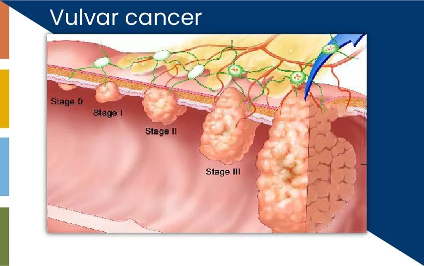 vulvar-cancer-jpg