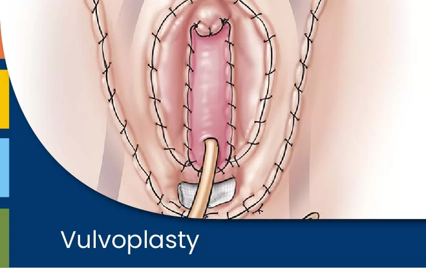 vulvoplasty-jpg